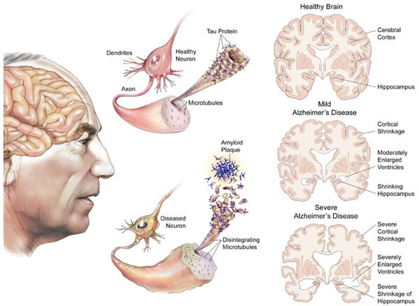 Các giai đoạn của bệnh Alzheimer 1